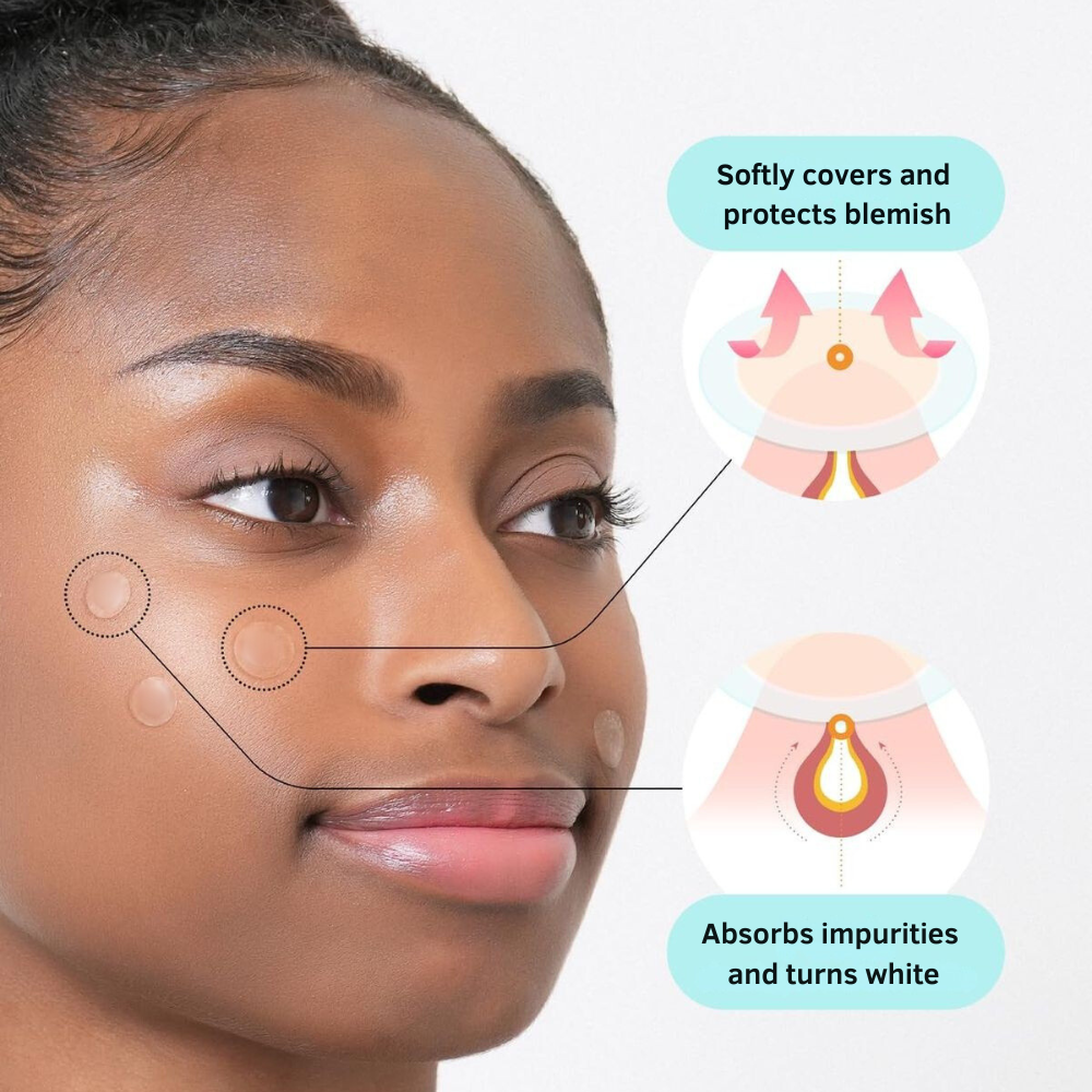 Dots To Spots 36 of 12mm Acne Patches – Rapid Healing Solution by Beauty To Fragrances