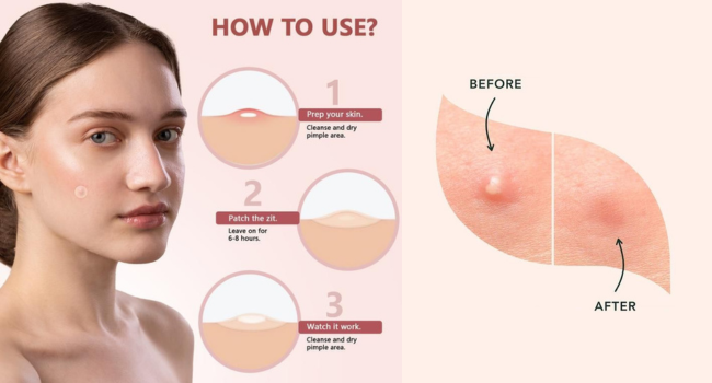 Dots To Spots 36 of 12mm Acne Patches – Rapid Healing Solution by Beauty To Fragrances